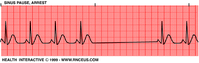 for complete heart block,