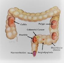 Colon And Rectal Cancer Types Of Blood Transfusion