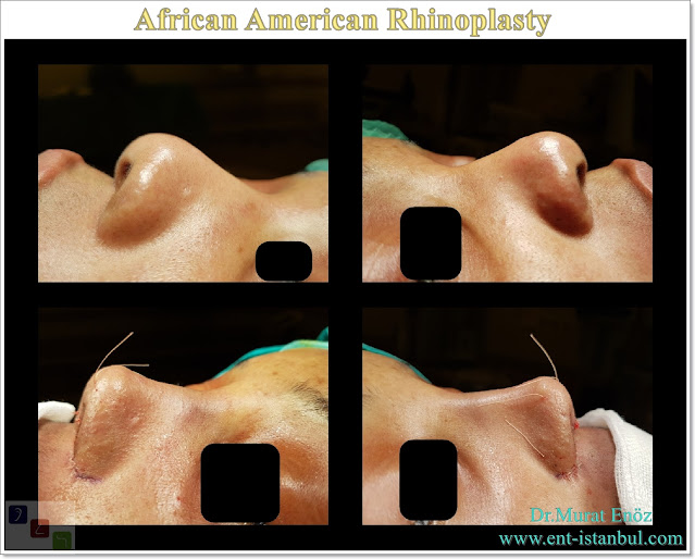 African American rhinoplasty,Thick skin nose job,Ethnic expert rhinoplasty surgeon,Black nose job,Ethnic Rhinoplasty Istanbul,