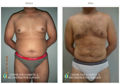 Liposuction in Mumbai