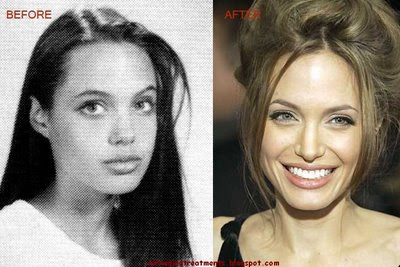 Angelina Jolie Plastic Surgery Before And After