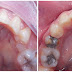 Class 1 with moderate crowding 16 years old patient treatment completed by Dr Mohamed Hegazy