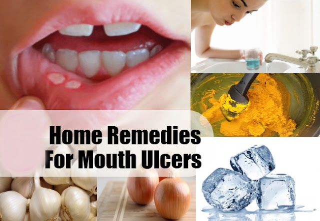 home-remedies-to-cure-mouth-ulcer