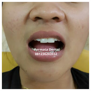 gambar foto contoh sebelum dan sesudah veneer gigi kelinci buatan manis cantik bali jember banyuwangi murah berkualitas di PERMATA DENTAL gambar gigi rusak yang di veneer gigi yang tidak rapi gigi renggang gigi patah cuil rompal pendek karies hitam kuning