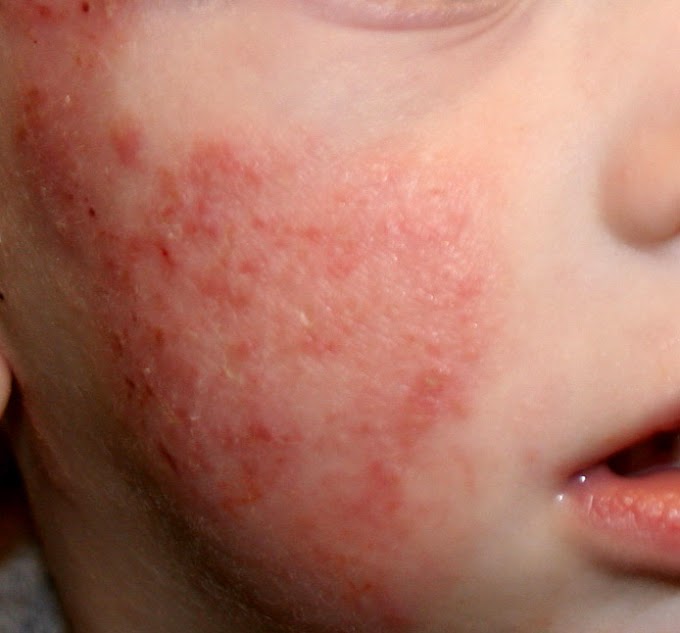 La dermatitis atópica