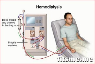 What is Hemodialysis, Hemodialysis