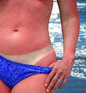 sunburned boater in a bikini