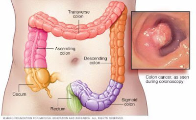 Gejala Kanker Kolon Dan Rektum