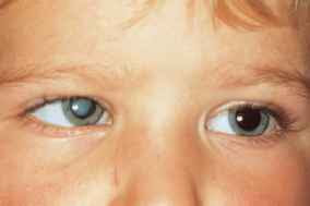 Congenital Cataract