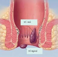 ĐIỀU TRỊ BỆNH TRĨ NỘI ĐỘ 1, 2