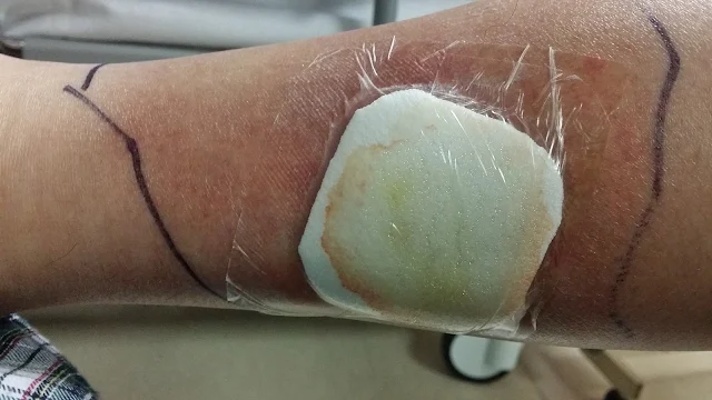 A large piece of tape over the Cellulitis wound
