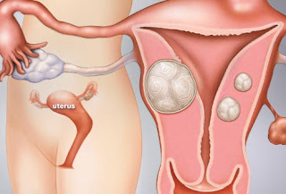obat mioma uteri