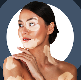 Homeopathic Doctor For Vitiligo Treatment In India