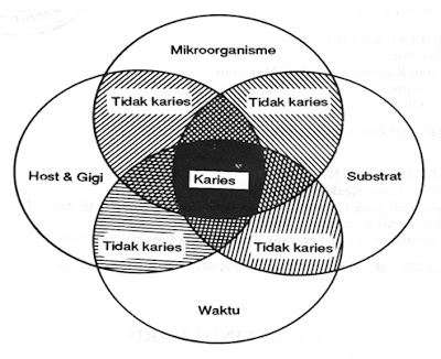 etiologi karies, resiko karies, faktor resiko karies, penyebab karies, mikroorganisme, substrat, gigi, host, waktu