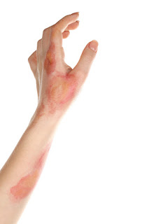 Emotional Effects of Burn Injury Victims in California