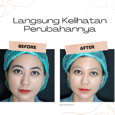 Terapi-HIFU-V-Shape-Di-Klinik-Holistik-Estetika