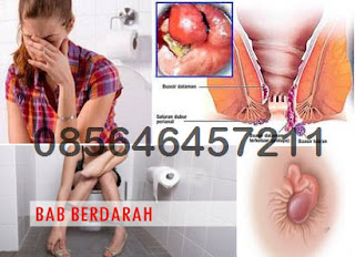 Obat Wasir di Apotik Online Harga Murah