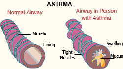 Asthma