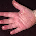 Penyakit Tangan Merah Dan Gatal