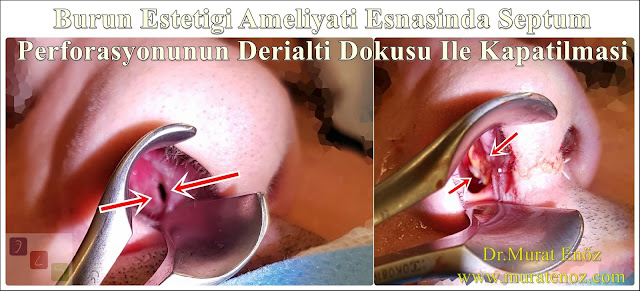 Deri altı dokusu ile septum perforasyonu tamiri - Deri altı dokusu ile septum perforasyonu ameliyatı - Septum perforasyonu tedavisi - Nazal septum perforasyonu operasyonu - Açık teknik septum perforasyonu ameliyatı - Açık teknik septum perforasyonu onarımı - Burun estetiği ile birlikte septum perforasyonu kapatılması - Burun septumunda delik kapatılması - Burun septum perforasyonu ameliyatı - Septum perforation closure in Istanbul - Septum perforation closure with under skin tissue - Closure of nasal septal perforations using under skin tissue - Combining rhinoplasty with septal perforation repair