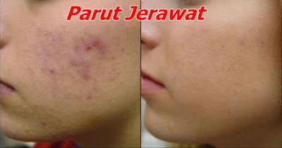 7 Cara Mudah Hilangkan Parut Jerawat Secara Semulajadi