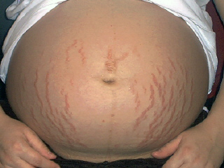 Cara Menghilangkan Stretch Mark Secara Alami