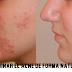 Como eliminar el acne