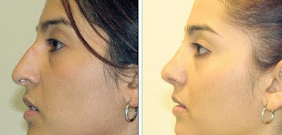 Rhinoplasty Pictures