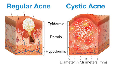 Acne and its causes, types and treatments
