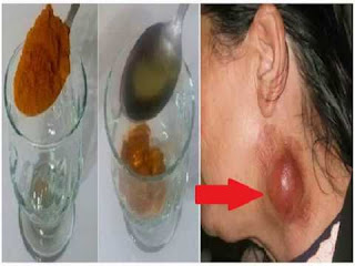 obat kanker leher yang paling ampuh