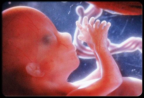 Abortion Pictures 5 Weeks. before 24 weeks of age,