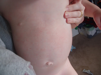 infant heat rash pictures. infant heat rash pictures.