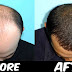 How To Stop Hair Fall For Men, Cure Hair Loss, Cure Baldness