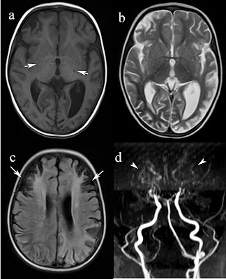 Radiodiagnosis - Imaging is Amazing-Interesting cases: MOYAMOYA DISEASE