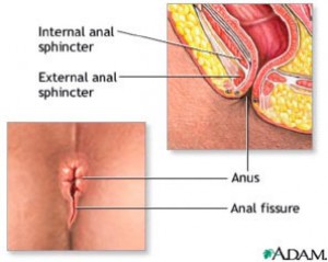 Nama Obat Untuk Ambeien