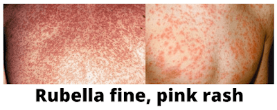 Rubella (German Measles)