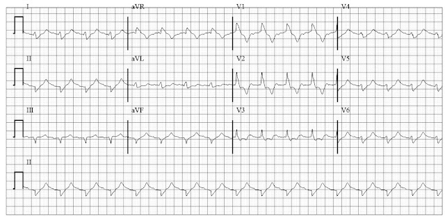 ECG