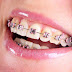 Phục hình răng Implant nha khoa ở đâu hiệu quả?