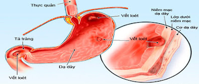 Cách khống chế axit dư thừa trong dạ dày