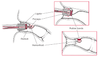 hemmroid banding pic