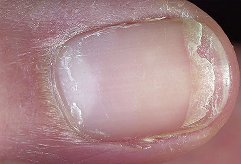 Dry Brittle Splitting Nails