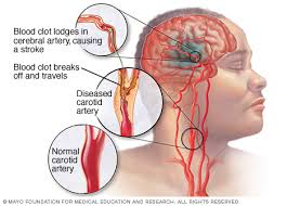 cara cepat mengobati penyakit stroke hemoragik, cari obat alami untuk sakit stroke ringan, Obat Untuk Stroke Ringan