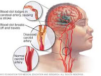 cara cepat mengobati penyakit stroke hemoragik