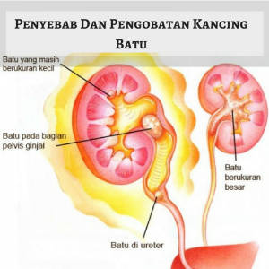 cara menghancurkan batu ginjal tanpa operasi,obat batu ginjal,obat kencing batu,cara mengeluarkan batu ginjal tanpa operasi,cara menghilangkan batu ginjal tanpa operasi