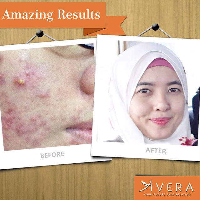 Hilangkan Jerawat Dengan Avera Acne Serum