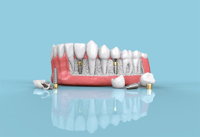 Cấy ghép răng implant mang ưu điểm gì?