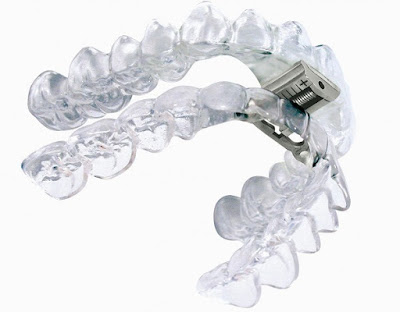 Chia sẻ niềng răng invisalign có đau không tới khách hàng-2