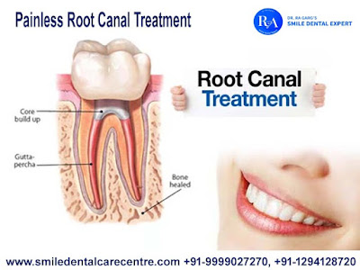 Painless Root Canal Treatment in Faridabad