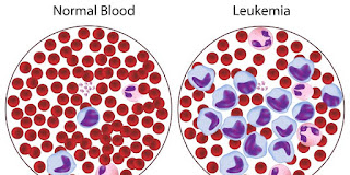 Cara Menyembuhkan Leukimia