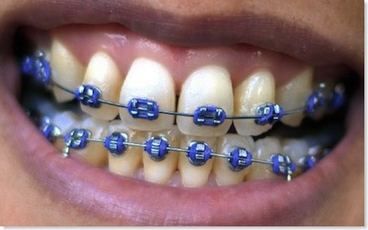 braces